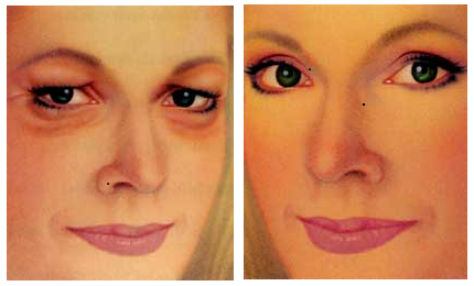 Blepharoplastie