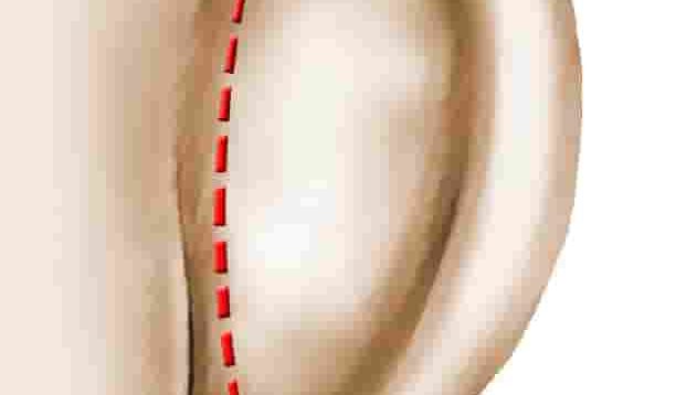 chirurgie_des_oreilles_decollees