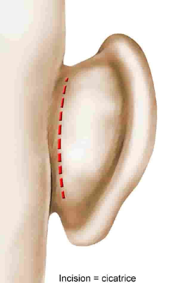 chirurgie_des_oreilles_decollees
