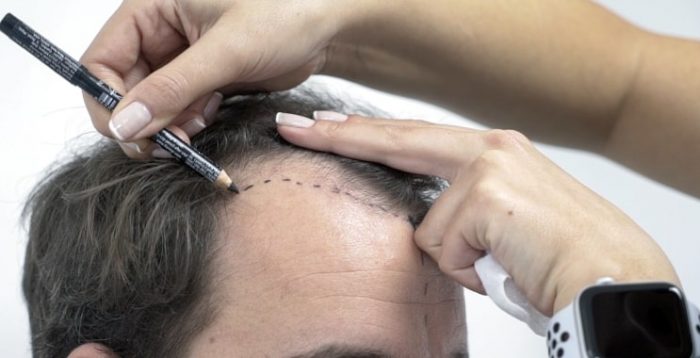 mcan-health-hair-transplantation-before